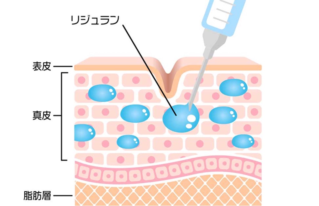 リジュラン®とは